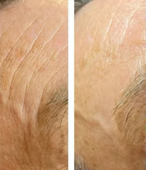 Antes e depois — Rejuvenescimento facial com LONO Cold Plasma