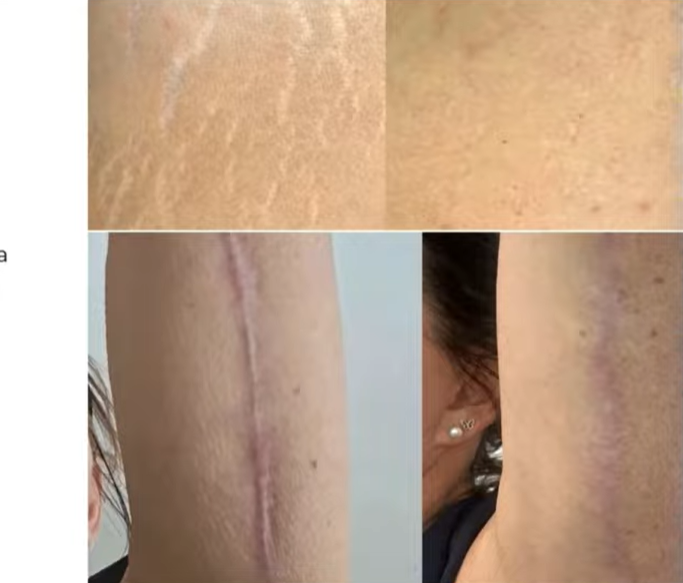 Antes e depois — Estrias e cicatrizes atróficas com LONO Cold Plasma
