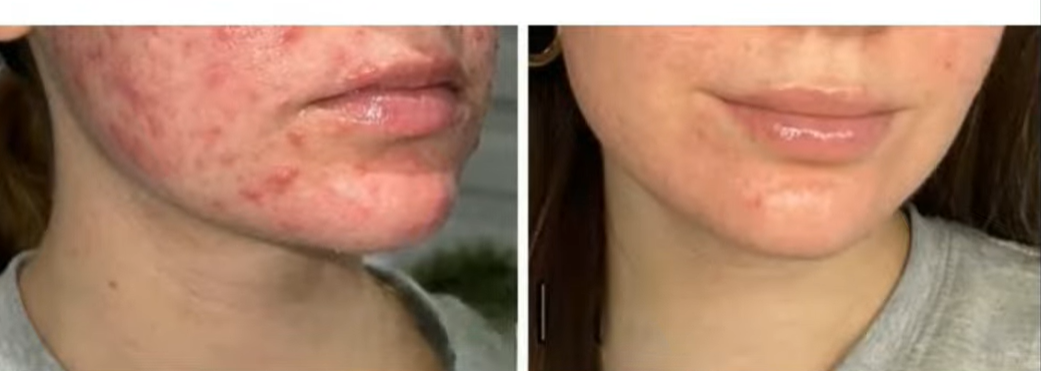 Antes e depois — Acne ativa e inflamatória com LONO Cold Plasma