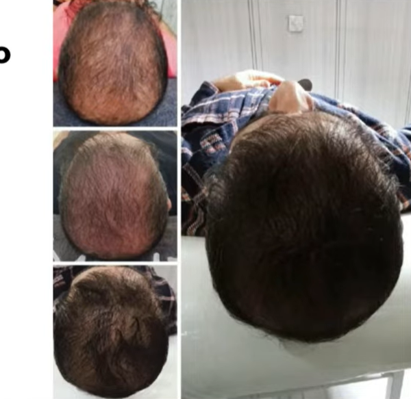 Antes e depois — Alopecia e estímulo capilar com LONO Cold Plasma
