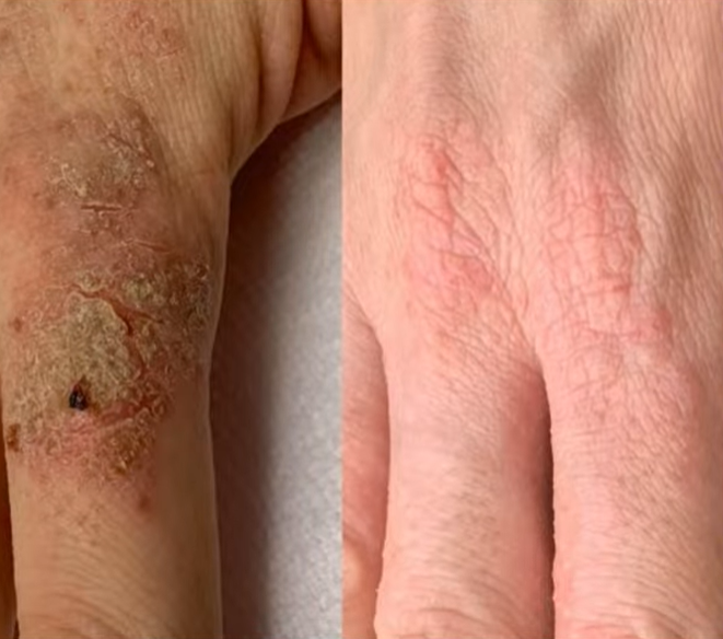 Antes e depois — Rosácea e dermatites com LONO Cold Plasma