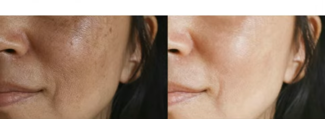 Antes e depois — Discromias e melasma com LONO Cold Plasma