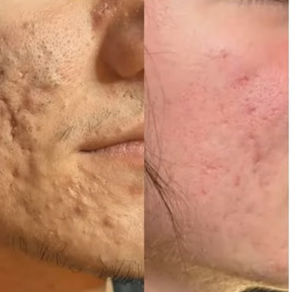 Antes e depois — Cicatrizes de acne com LONO Cold Plasma